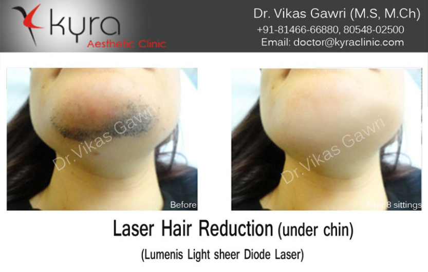 Laser Hair Removal